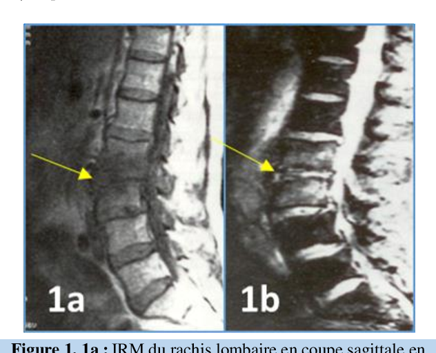 Spondylodiscite traitement naturel Spondylodiscite traitement naturel